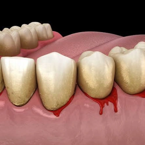 Bleeding Gums Treatment