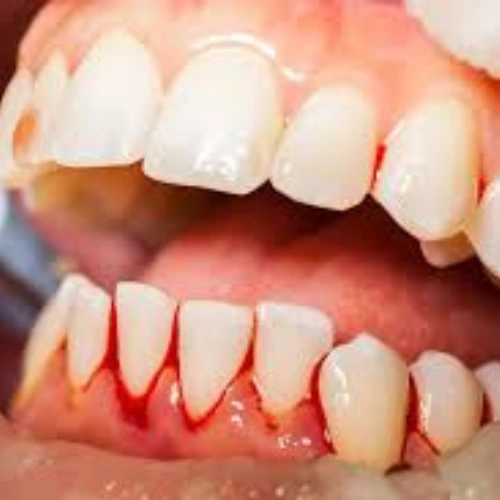 Bleeding Gums _ Oral Injury