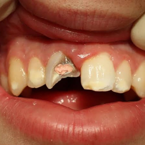 Broken or Chipped Tooth