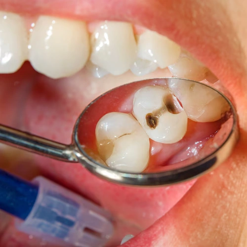 Cavity Detection & Prevention