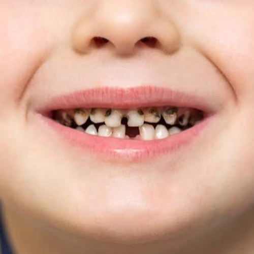 Cavity Treatment for Children