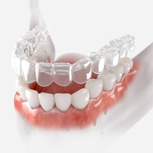 Clear Aligners