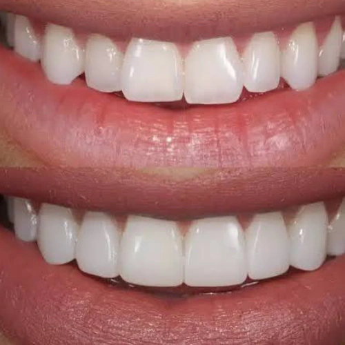 Composite Bonding