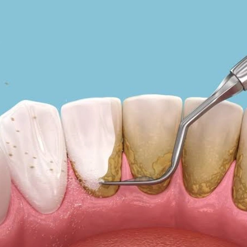 Deep Cleaning _ Root Planing