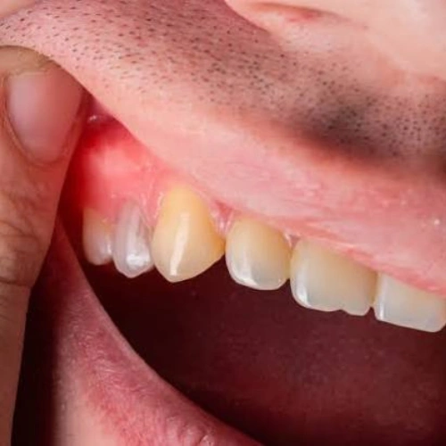 Dental Abscess