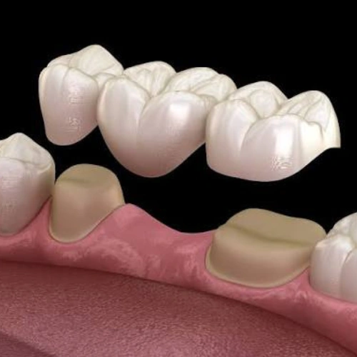 Dental Bridges