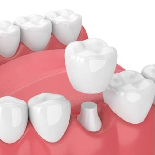 Dental Crowns & Caps
