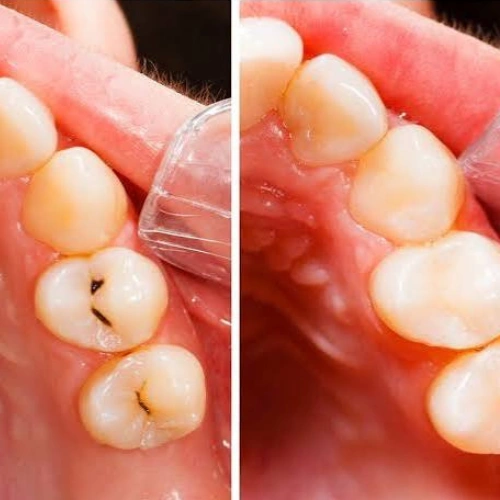 Dental Fillings for Cavities