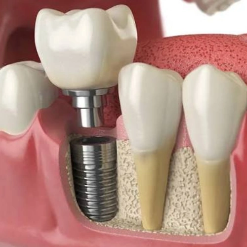 Dental Implants