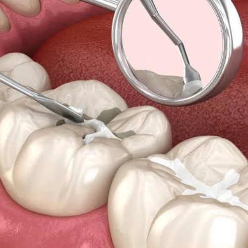 Dental Sealants