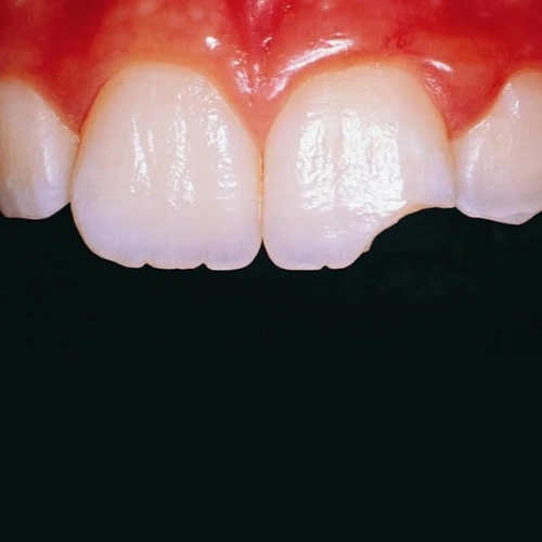 Dental Trauma