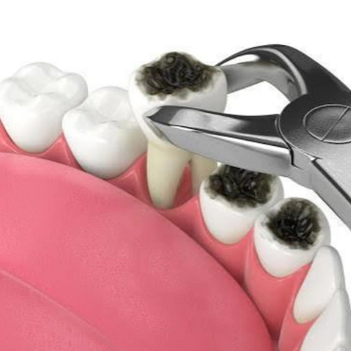 Emergency Tooth Extraction