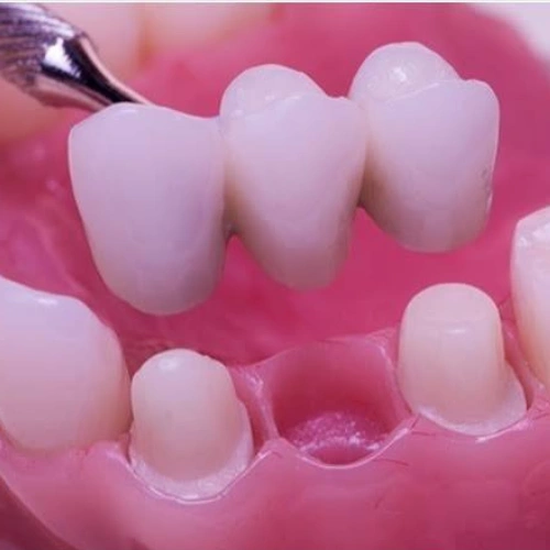 Fixed Dental Bridges