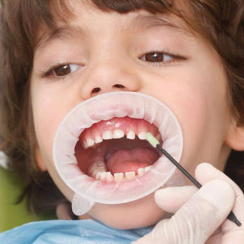 Fluoride Application