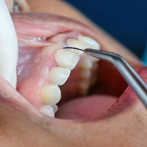 Gingivitis Treatment