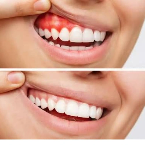 Gum Disease Treatment
