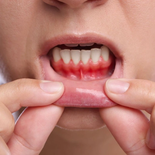 Gum Health Assessment