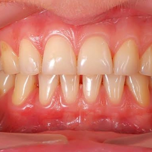 Gum Health Maintenance