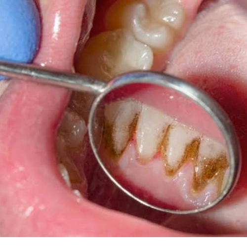 Gum Infection Treatment