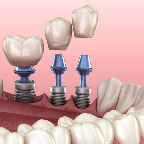 Implant-Supported Crowns