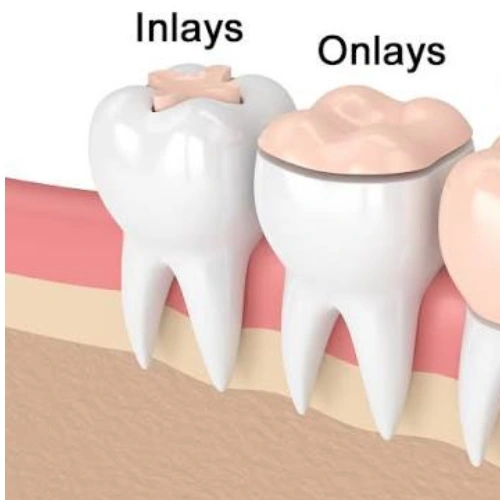 Inlays & Onlays