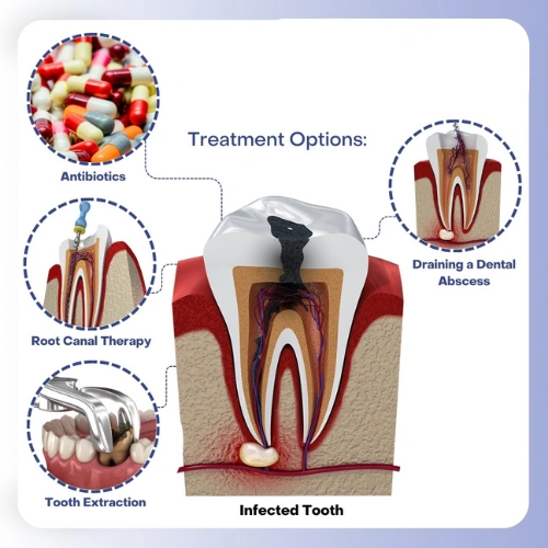 Management of Dental Infections