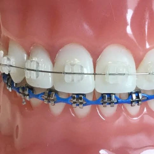 Metal & Ceramic Braces