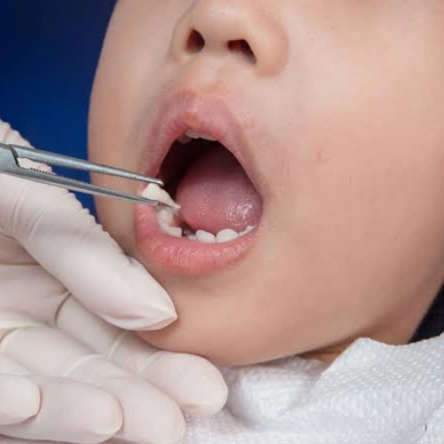 Milk Tooth Extraction