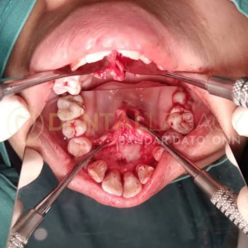 Minor Oral Surgical Procedures