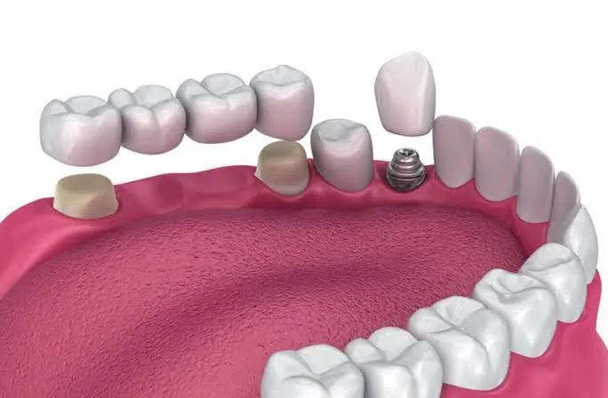 Missing Teeth & Tooth Replacement