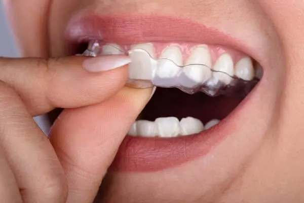Orthodontic & Teeth Alignment