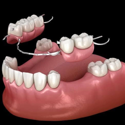 Partial Dentures