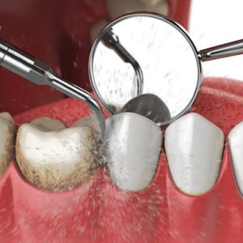 Periodontitis Management