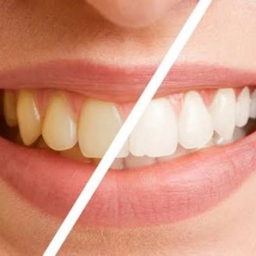 Professional Teeth Cleaning