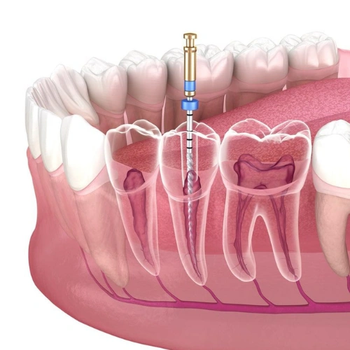 Re-RCT _ Root Canal Retreatment