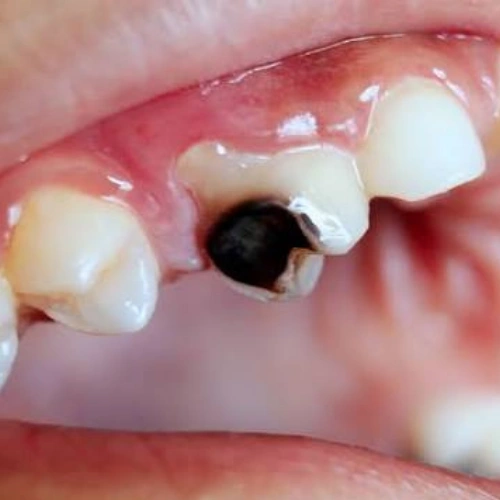 Removal of Damaged Teeth