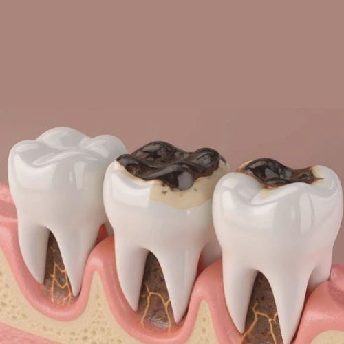 Restoration of Worn or Damaged Teeth