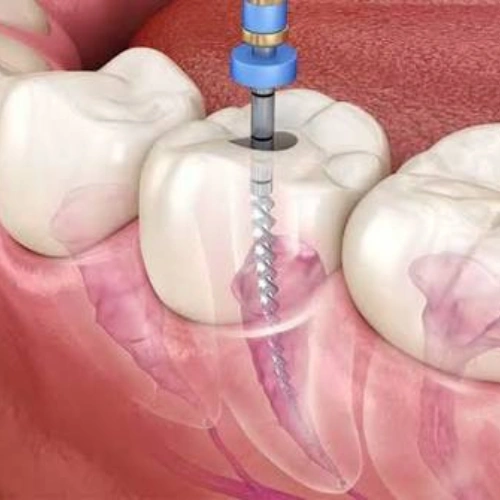 Root Canal Treatment (RCT)