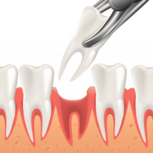 Simple Tooth Extraction