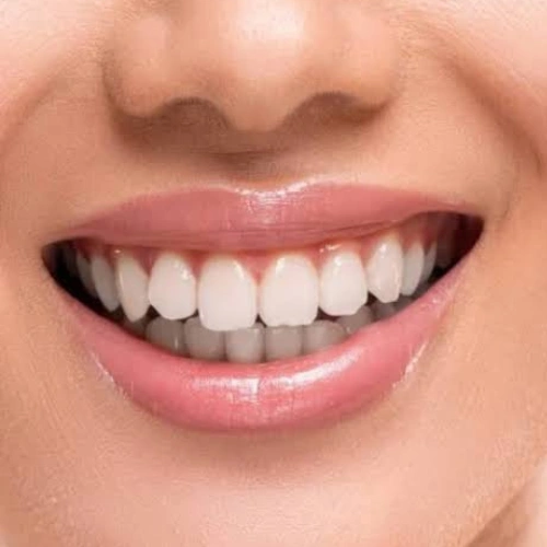 Smile Enhancement