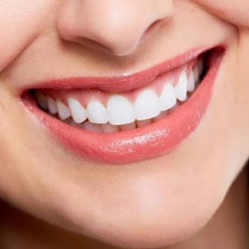 Smile Makeover