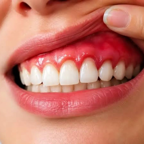 Swelling & Gum Pain