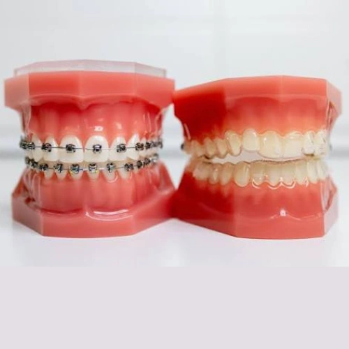 Teeth Alignment