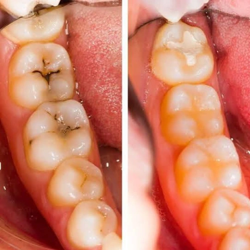 Tooth-Coloured Cosmetic Restorations