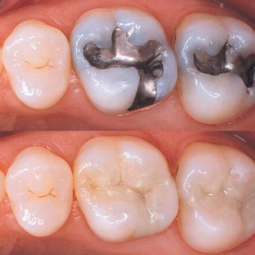 Tooth-Coloured Fillings