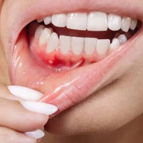 Tooth Infection