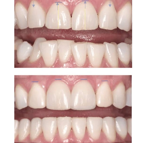 Tooth Reshaping & Contouring