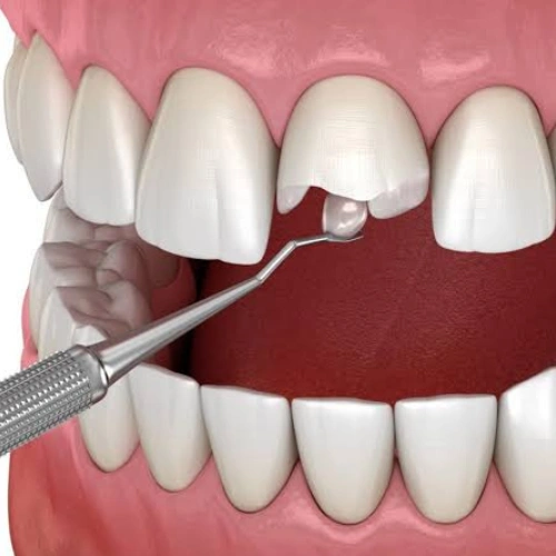 Treatment of Broken or Fractured Teeth