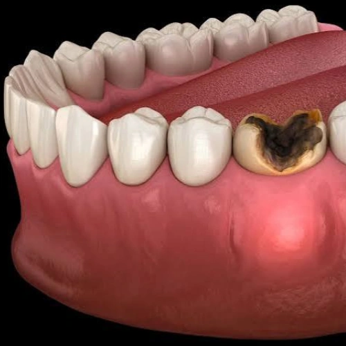 Treatment of Dental Abscess