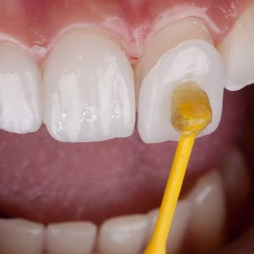 Veneers _ Laminates